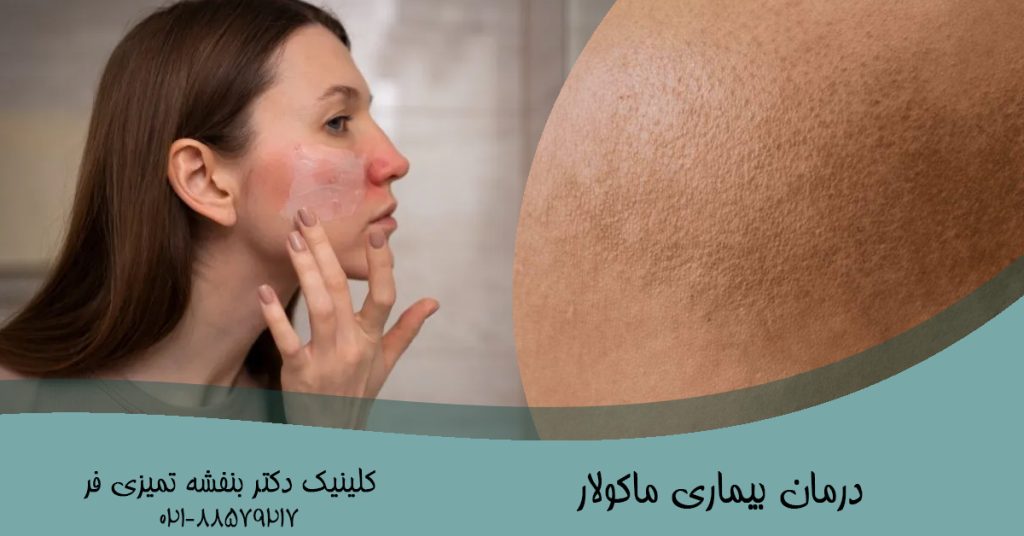 درمان بیماری ماکولار
