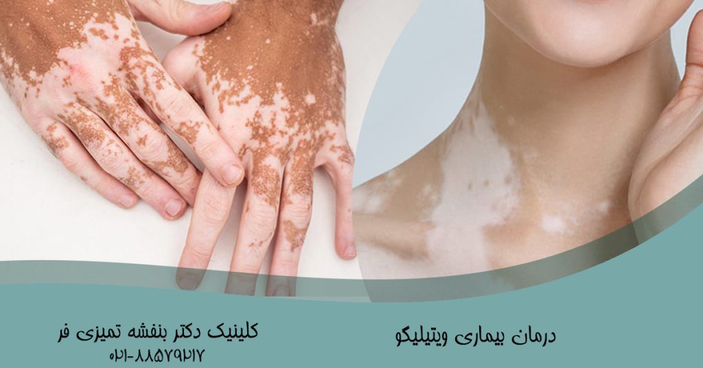 درمان پیسی یا ویتیلیگو
