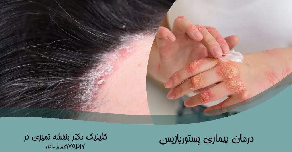 درمان بیماری پستوریازیس