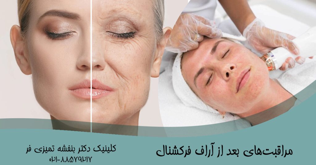 مراقبت‌های بعد از آر‌اف فرکشنال