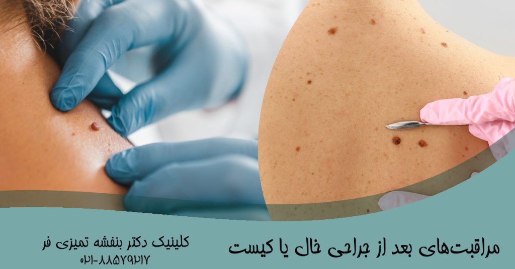 مراقبت‌های بعد از جراحی خال یا کیست