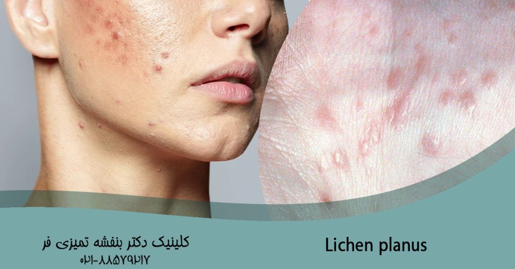 لیکن پلان Lichen planus