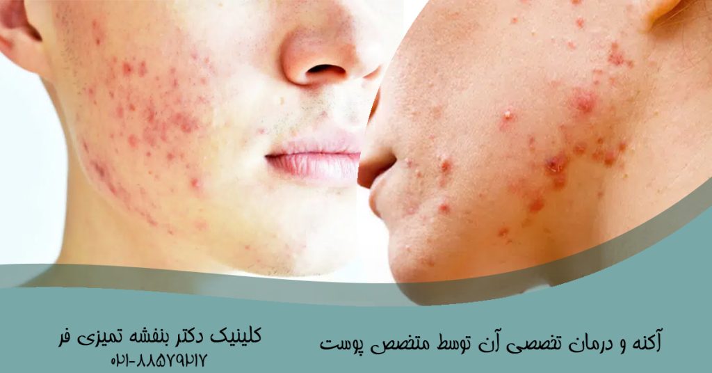آکنه و درمان تخصصی آن توسط متخصص پوست