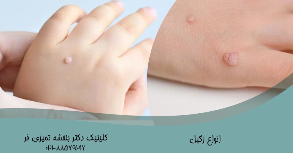 زگیل