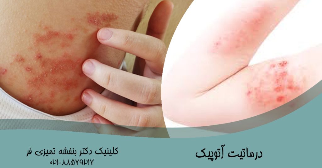 درماتیت آتوپیک