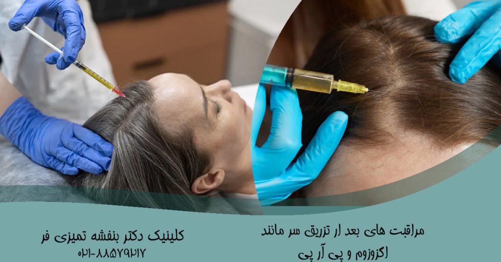 ​مراقبت‌های بعد از تزریق‌های داخل سر مانند مزوتراپی, پی‌آرپی (PRP), اگزوزوم، SVF و ...