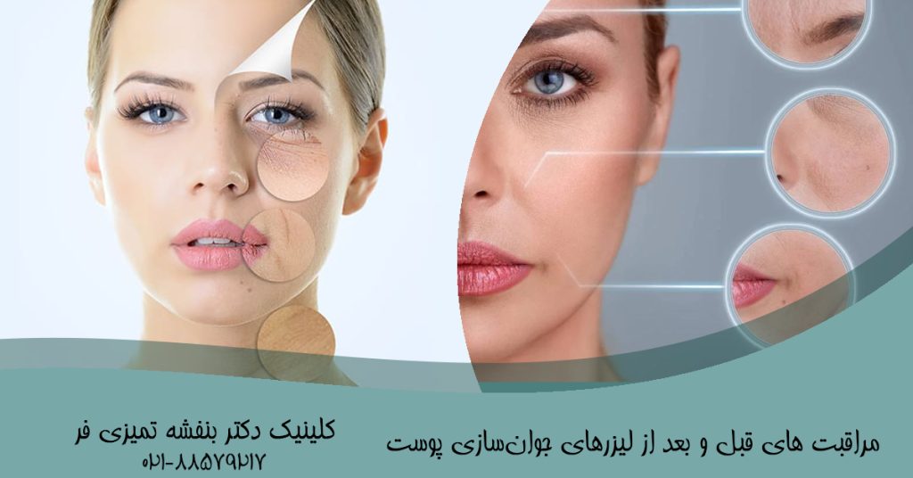 مراقبت های قبل و بعد از لیزرهای جوان‌سازی پوست
