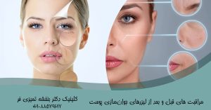 مراقبت های قبل و بعد از لیزرهای جوان‌سازی پوست