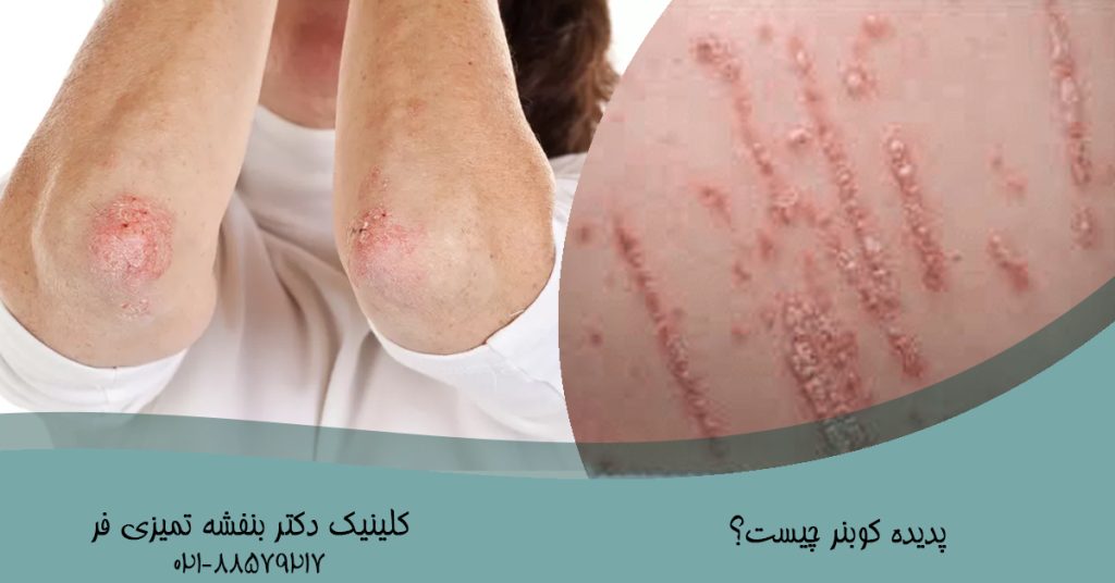درمان بیماری کوبنر در کلینیک دکتر بنفشه تمیزی فر