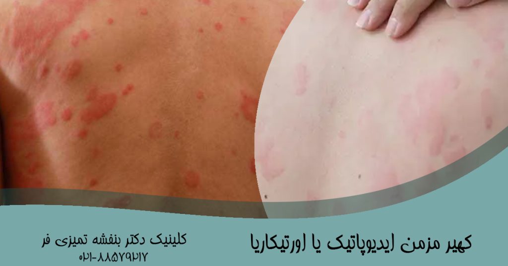 کهیر مزمن ایدیوپاتیک یا اورتیکاریا