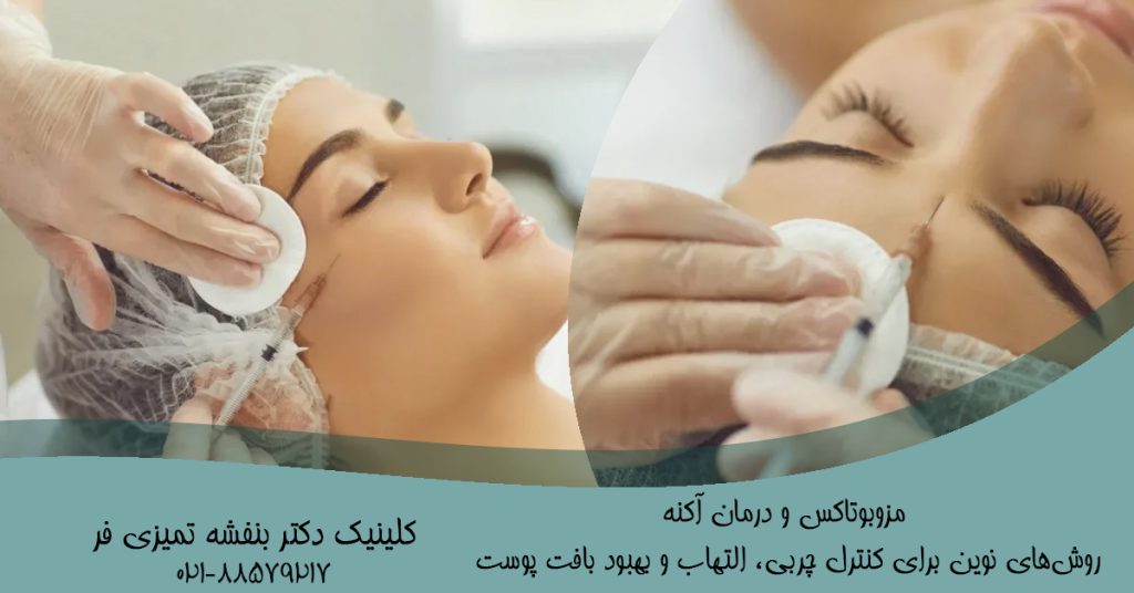 مزوبوتاکس و درمان آکنه | روش‌های نوین برای کنترل چربی، التهاب و بهبود بافت پوست