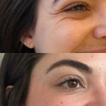 بوتاکس خطوط پنجه کلاغی