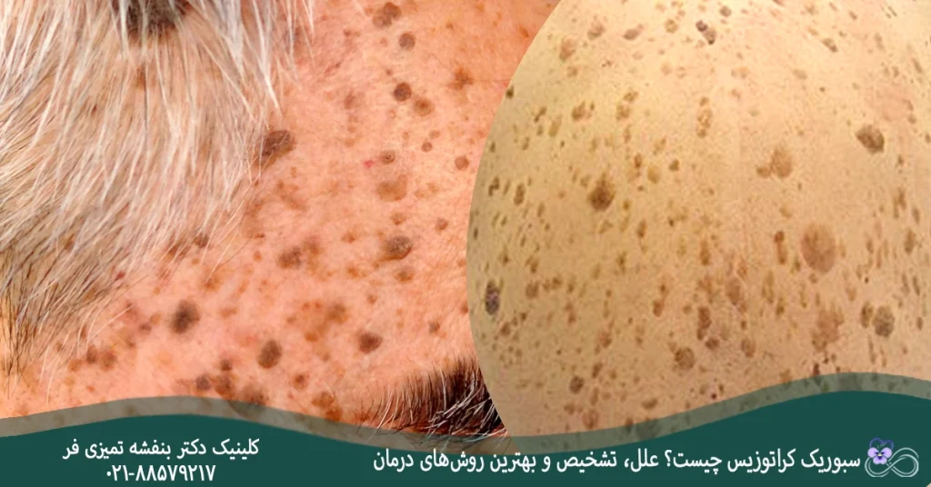 سبوریک کراتوزیس چیست؟ علل، تشخیص و بهترین روش‌های درمان