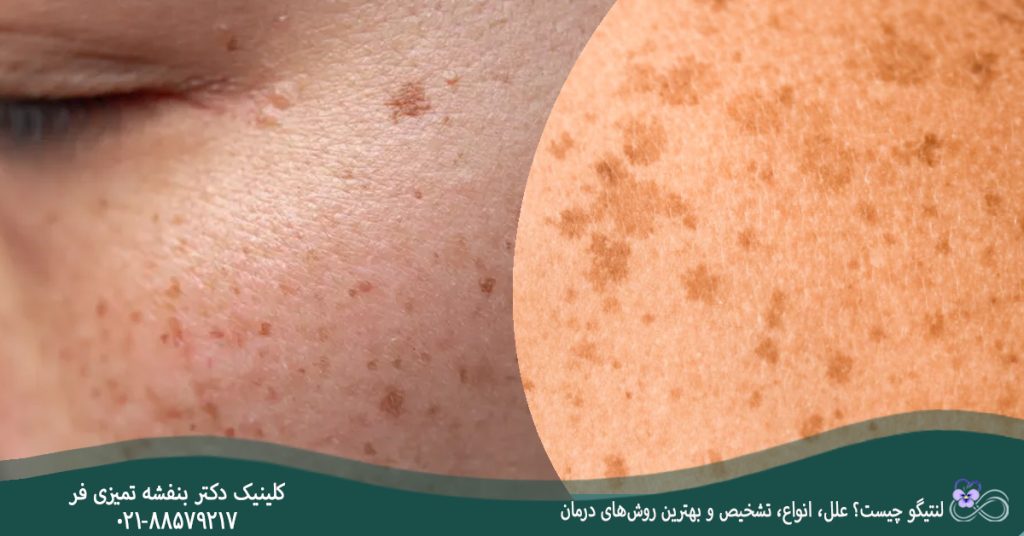 لنتیگو چیست؟ علل، انواع، تشخیص و بهترین روش‌های درمان