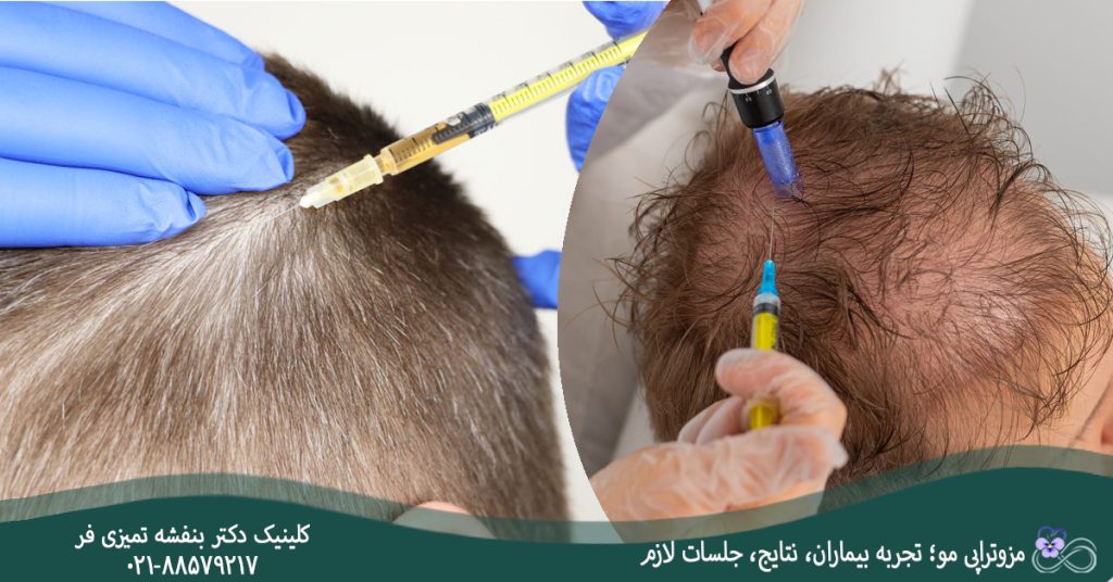 مزوتراپی مو؛ تجربه بیماران، نتایج، جلسات لازم