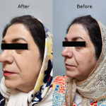 لیزر لک و خال