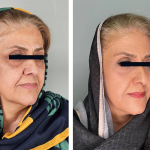 تیرگی دور چشم