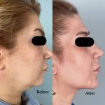 سل بوستر بازسازی کننده چربی