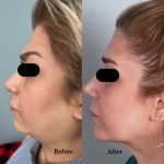 سل بوستر بازسازی کننده چربی